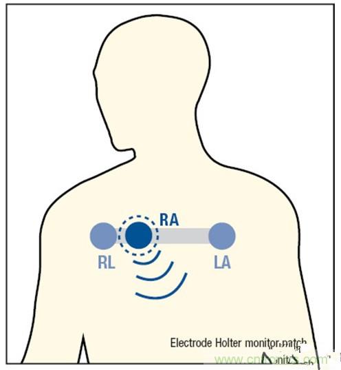 解析:一款可穿戴無線ECG動態(tài)心電監(jiān)護(hù)儀的設(shè)計(jì)